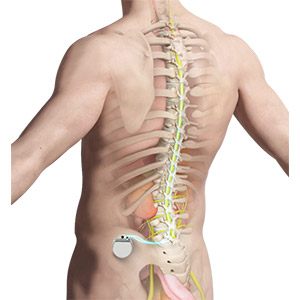 Spinal Cord Stimulator pic
