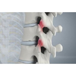 Spine Arthritis pic