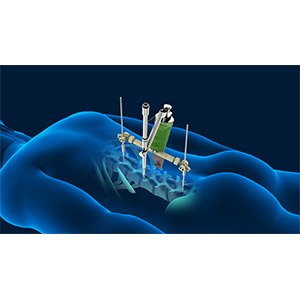 Q Guidance Spine Surgery pic
