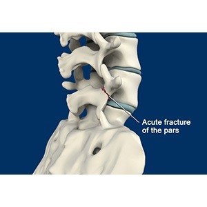 Spondylolisthesis pic