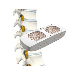 XLIF - Extreme Lateral Interbody Fusion pic