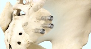 iFuse TORQ Implant System  Pic