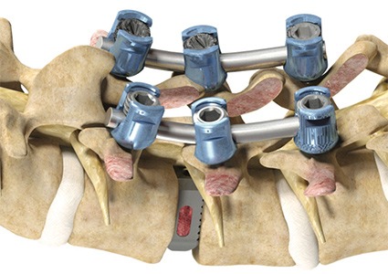 Picture of Mako Spine Lumbar Interbody Fusion
