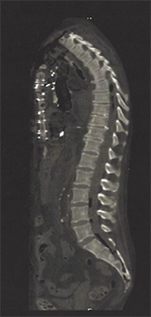 Picture of Mako Spine Scan