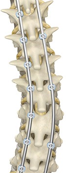 Picture of Mako Spine Scoliosis Correction