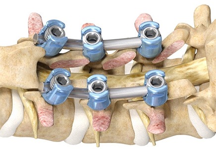 Picture of Mako Spine Spinal Decompression