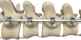 Picture of Mako Spine Spinal Fusion