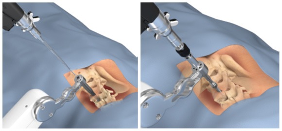 Picture of Mako Spine Mako Treatment Instrument Pre-Planned Placement