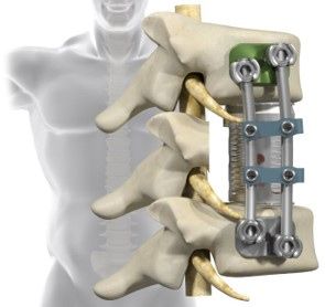 Picture of Mako Spine Vertebral Body Replacement