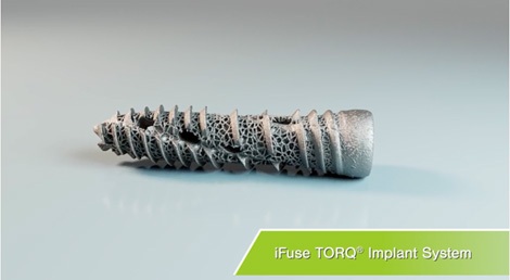 surface of iFuse TORQ Pic