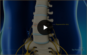 Degenerative Disc Disease - Video Picture
