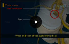 Disc Herniation - Video Picture