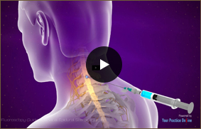 Fluoroscopy Guided Cervical Epidural Steroid Injection - Video Picture