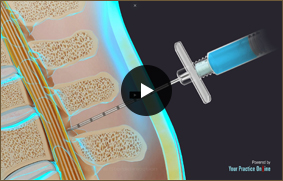 Fluoroscopy Guided Lumbar Epidural Steroid Injection - Video Picture