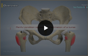 Hip Bursitis - Video Picture