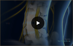 The mild&reg; Procedure for Spinal Stenosis - Video Picture