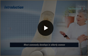 Osteoporosis - Video Picture