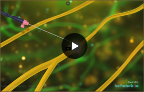 Radiofrequency Ablation - Video Picture