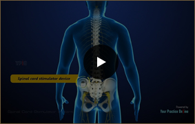 Spinal Cord Stimulator - Video Picture