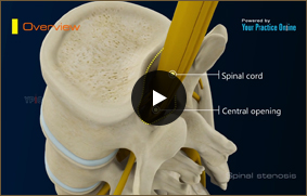 Spinal Stenosis - Video Picture