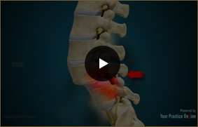 Spondylolisthesis - Video Picture