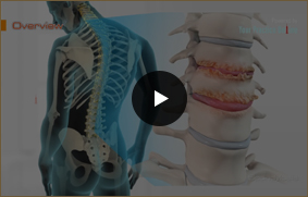 Spondylosis - Video Picture