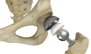Complex Primary Hip Replacement pic