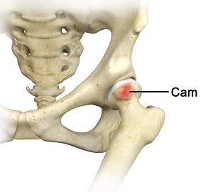 Femoral Cam Deformity pic