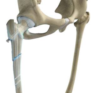 Femoral Nails pic