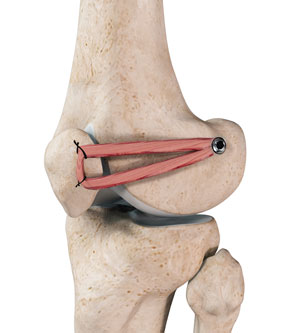 Patellofemoral Knee Replacement pic