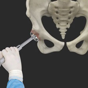 Robotic Assisted Hip Replacement pic