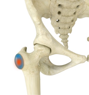 Trochanteric Bursitis pic