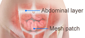 Abdominal Wall Reconstruction icon