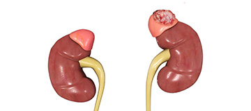 Adrenal Tumors< icon