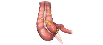 Appendectomy icon