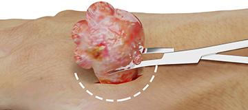 Benign Soft Tissue Tumors icon