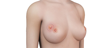 Breast Abscesses icon