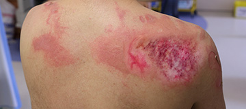 Burn Surgery Service