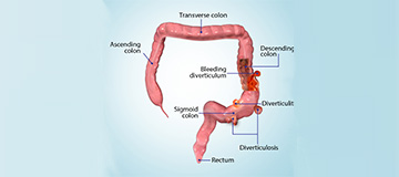Diverticular Disease icon