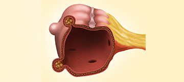Diverticulosis icon