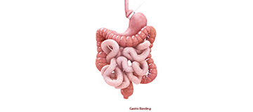 Gastric Restrictive Surgery icon
