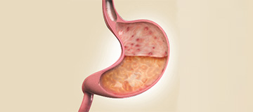 Gastritis icon