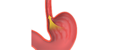 Gastroesophageal Reflux Disease icon
