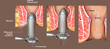 Hemorrhoidectomy icon