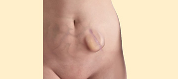 Incisional Hernia Repair icon