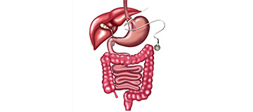 Laparoscopic Adjustable Gastric Banding Icon