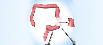 Laparoscopic Colon Resection icon