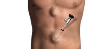 Laparoscopic Hernia Repair icon