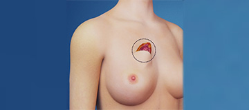 Lumpectomy icon