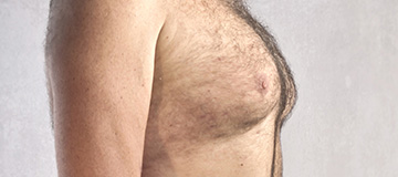 Male Gynecomastia icon